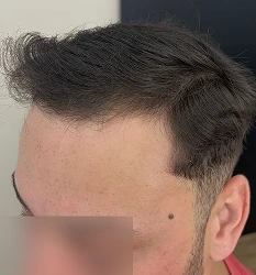 Afinamento no topo depois